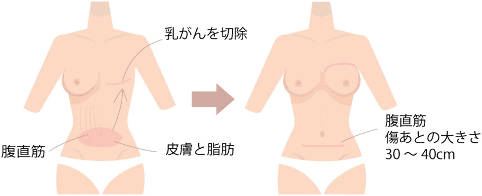 腹直筋皮弁の手術イメージ