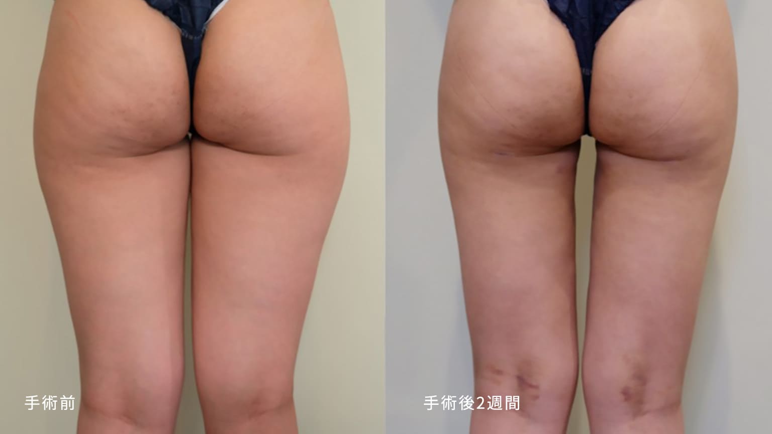 マイアミ美容外科での脂肪吸引の症例写真