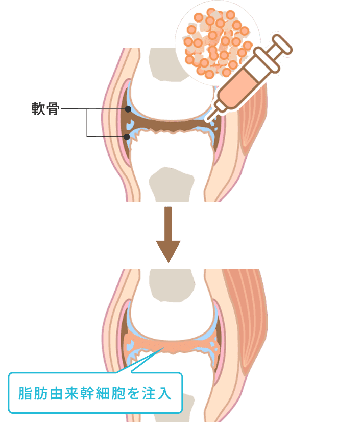 ひざに脂肪由来幹細胞を注入する図