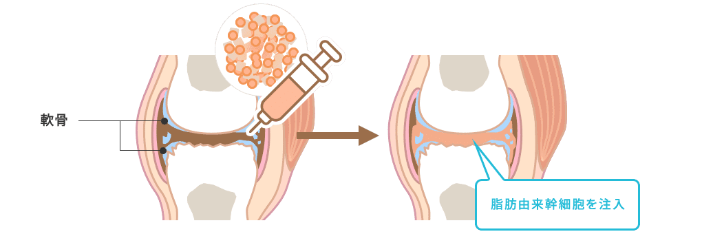 ひざに脂肪由来幹細胞を注入する図