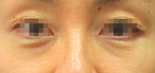 【50代女性】肌の再生医療による目の下のクマの治療 症例写真
