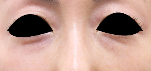 【40代女性】肌の再生医療による目の下のクマの治療 症例写真