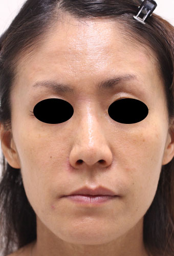 【40代女性】肌の再生医療による顔全体の治療 症例写真