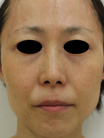 【40代女性】肌の再生医療による顔全体の治療 症例写真