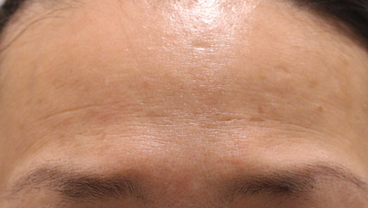 【40代女性】肌の再生医療によるおでこのシワの治療 症例写真