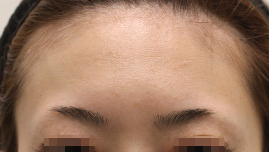 【30代女性】肌の再生医療によるおでこのシワの治療 症例写真