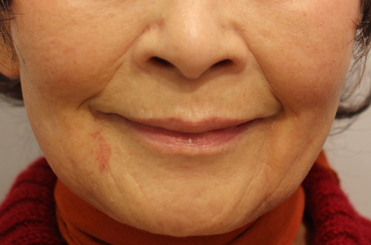 【80代女性】肌の再生医療による口周りの治療 症例写真