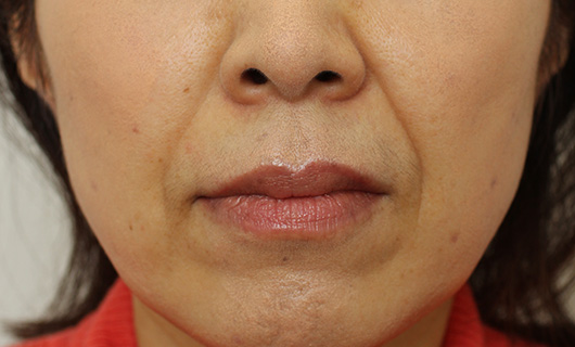 【50代女性】肌の再生医療によるほうれい線の治療 症例写真
