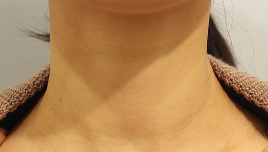 【30代女性】肌の再生医療による首のシワの治療 症例写真