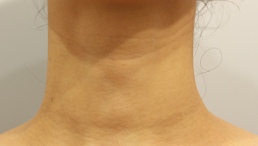 【30代女性】肌の再生医療による首のシワの治療 症例写真