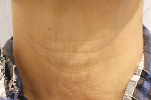 【60代女性】肌の再生医療による首のシワの治療 症例写真