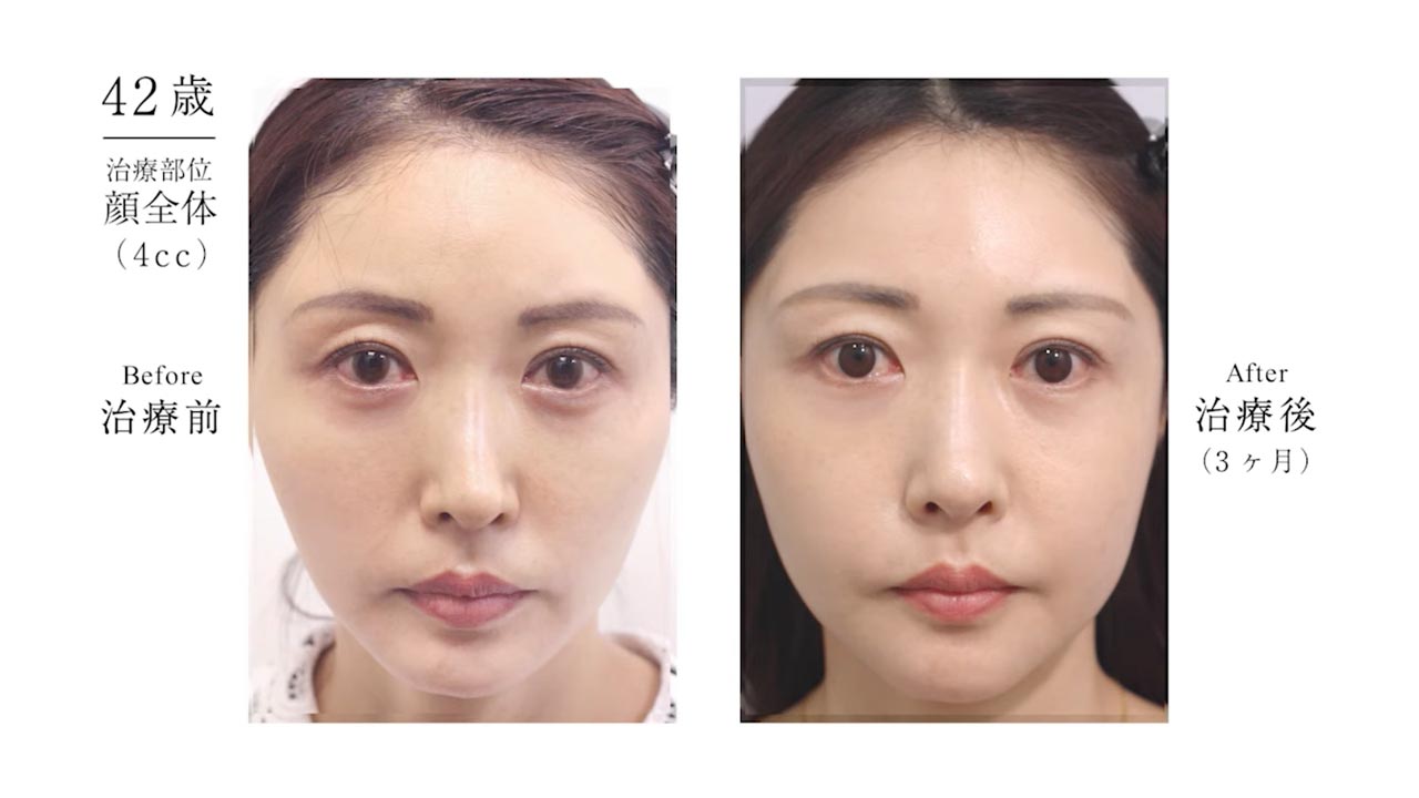 42歳、顔全体の治療（4cc）前後（3ヶ月）