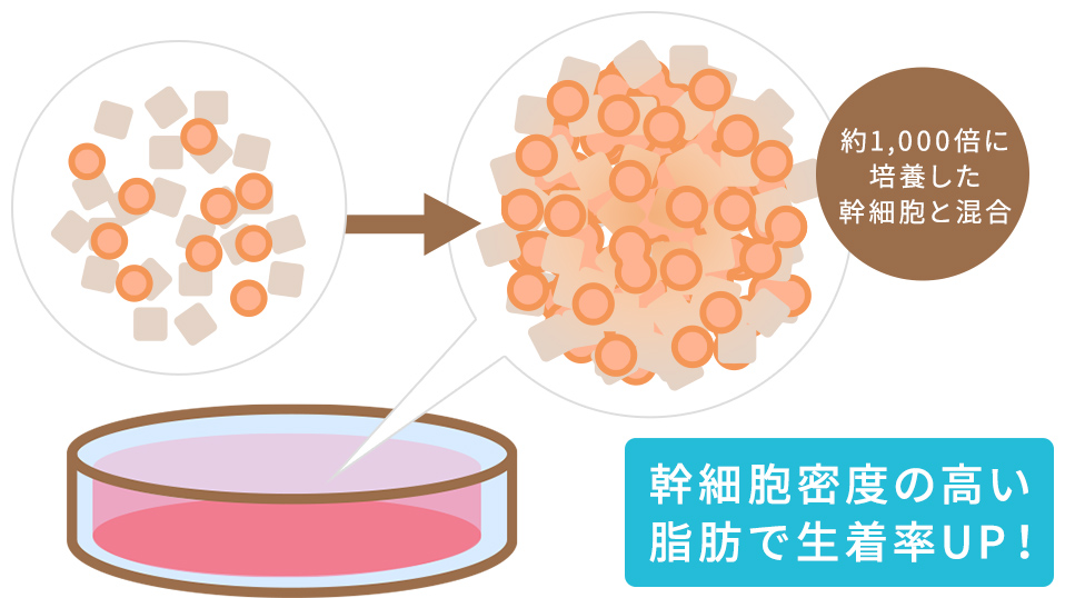 約1,000倍に培養した幹細胞と混合。幹細胞密度の高い脂肪で生着率UP！