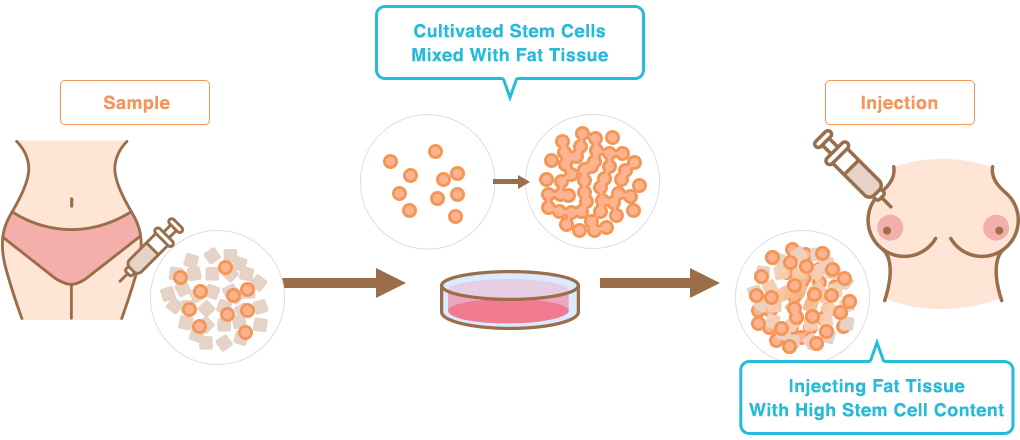 Sample→Cultivated Stem Cells Mixed With Fat Tissue→Injection: Injecting Fat Tissue With High Stem Cell Content