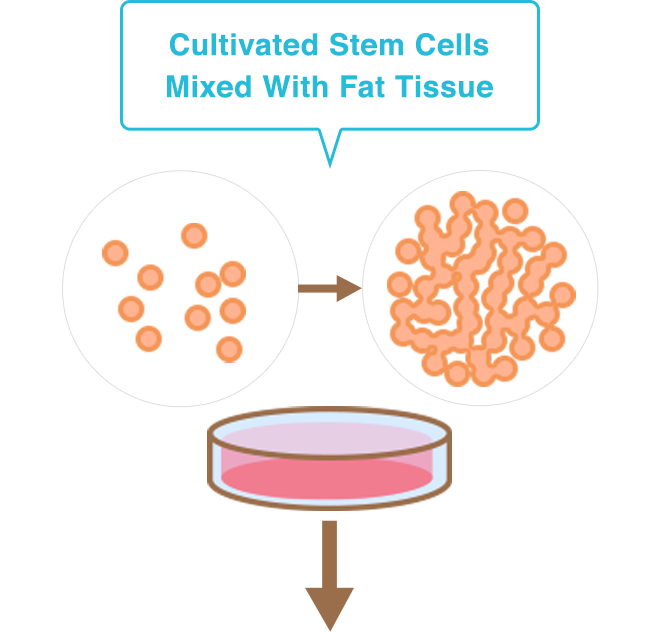 Cultivated Stem Cells Mixed With Fat Tissue