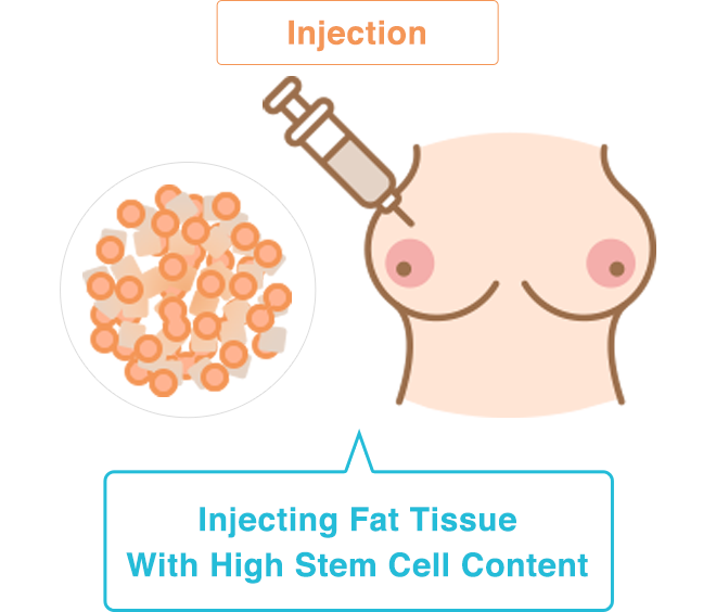 Injection: Injecting Fat Tissue With High Stem Cell Content